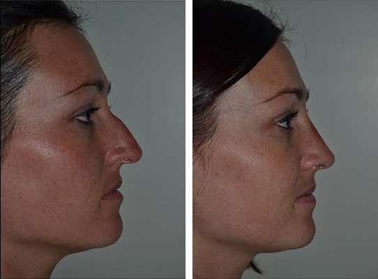 before & after photo of Rhinoplasty