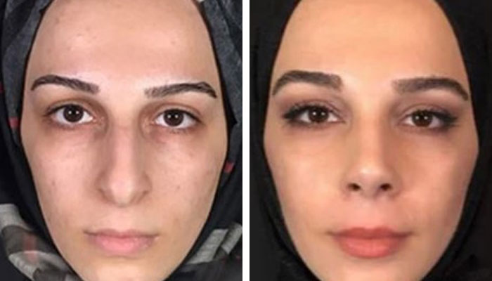 before & after photo of عملية تجميل الأنف