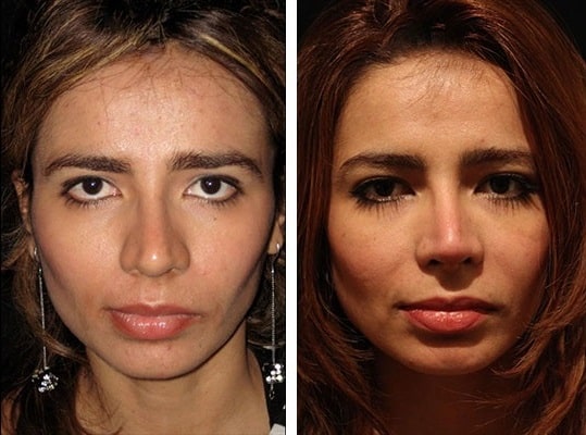 before & after photo of عملية تجميل الأنف