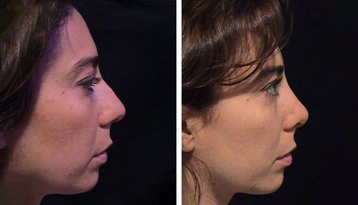 before & after photo of Rhinoplasty