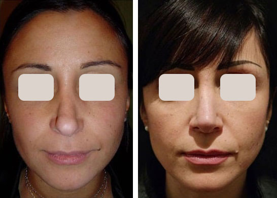 before & after photo of Rhinoplasty