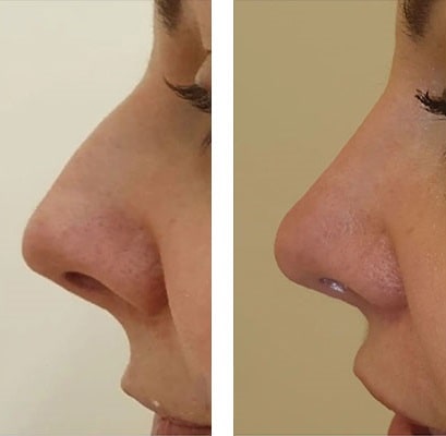 before & after photo of rhinoplasty