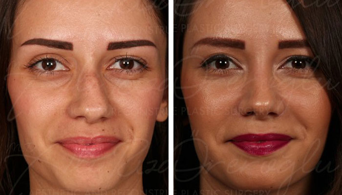 before & after photo of Facial Fat Transfer