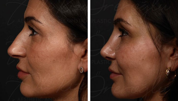 before & after photo of Facial Fat Transfer