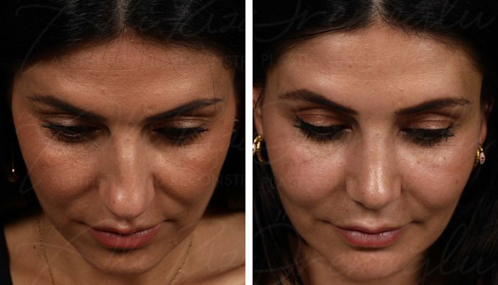 before & after photo of Facial Fat Transfer