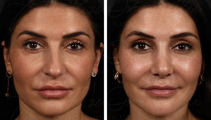 before & after photo of Facial Fat Transfer