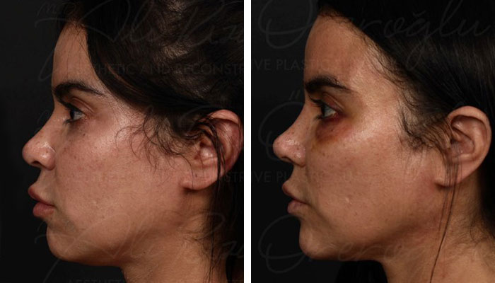 before & after photo of Facial Fat Transfer