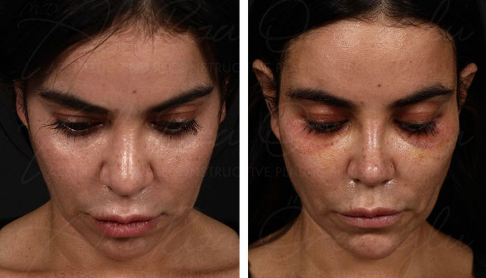 before & after photo of Facial Fat Transfer