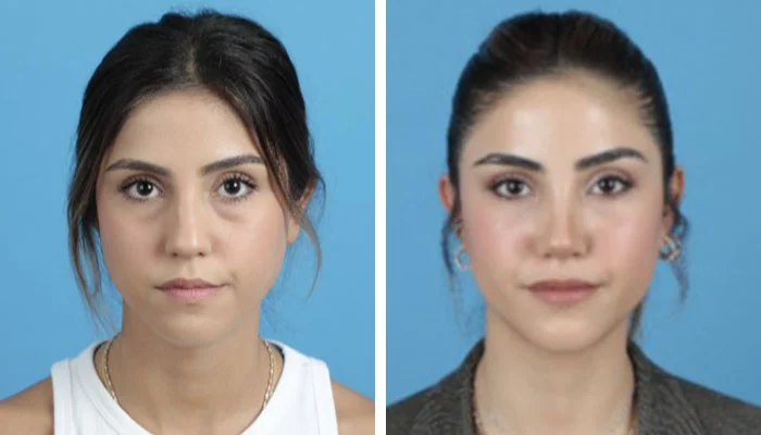 before & after photo of Rhinoplasty