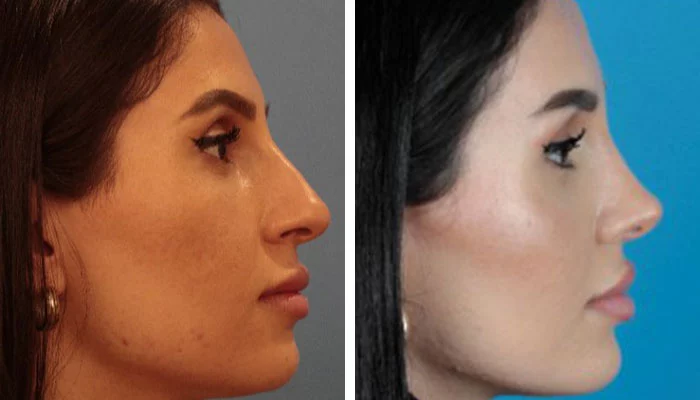 before & after photo of Rhinoplasty