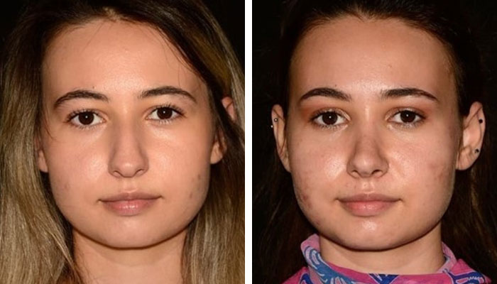 before & after photo of Rhinoplasty