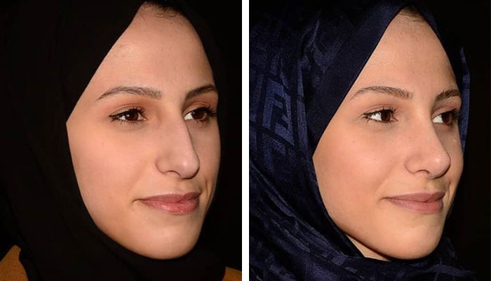 before & after photo of Rhinoplasty