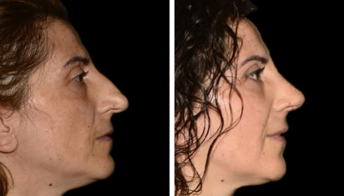 before & after photo of Rhinoplasty