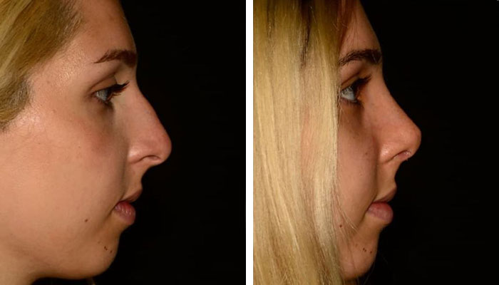 before & after photo of Rhinoplasty