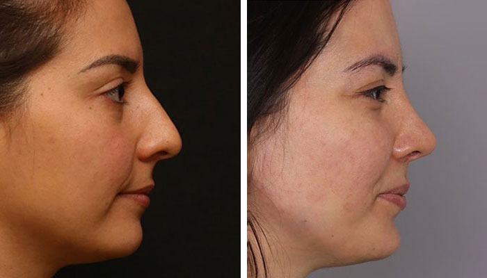 before & after photo of chin-jawline-filler