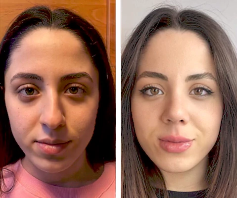 before & after photo of Eyelid Surgery