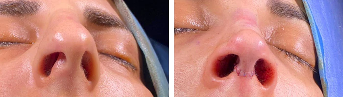 before & after photo of Eyelid Surgery