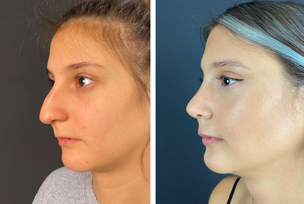 before & after photo of Rhinoplasty