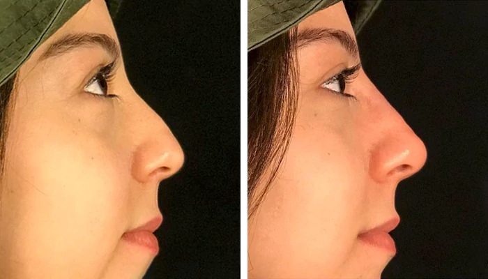 before & after photo of عملية تجميل الأنف