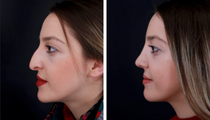 before & after photo of Rhinoplasty