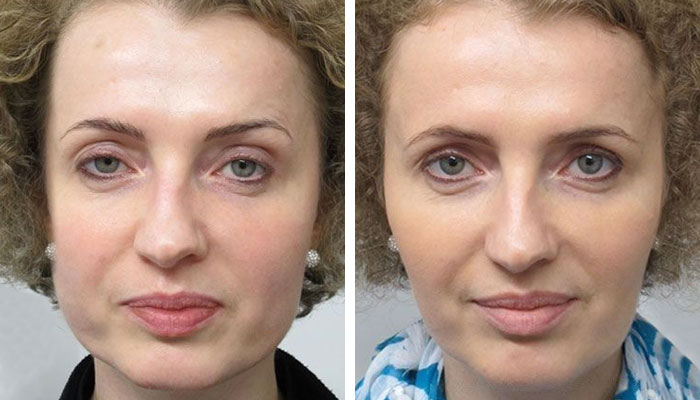 before & after photo of Square Jaw Reduction