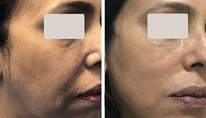 before & after photo of thread-lift