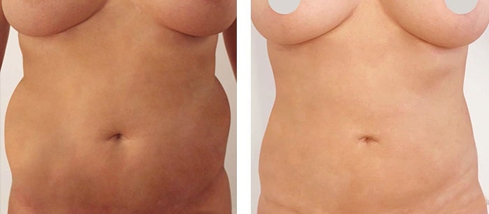 before & after photo of Tummy Tuck