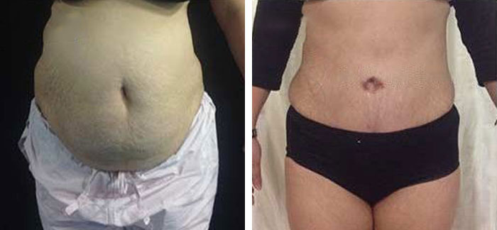before & after photo of Tummy Tuck