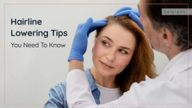 Hairline Lowering with Hair Transplant vs Scalp Advancement: Everything You Need to Know