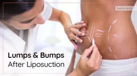 Lumps and Bumps After Liposuction