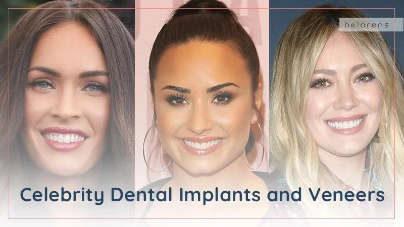 Celebrity Dental Implants and Veneers: How Do Famous Folk Change Their Smile?