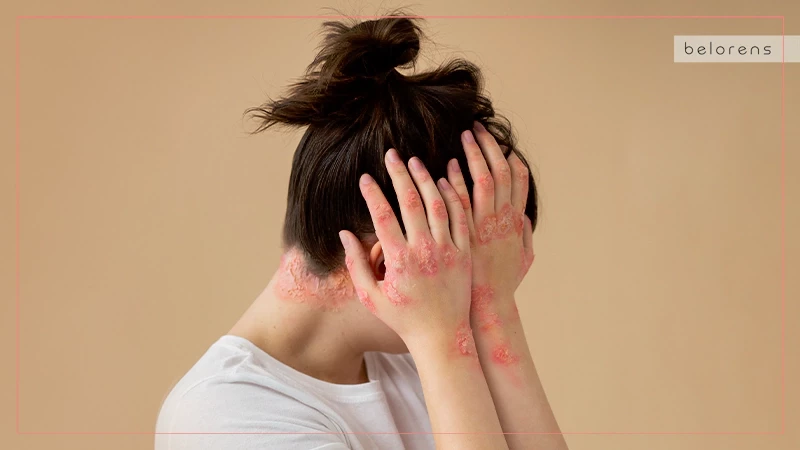 16 Causes of Facial Skin Redness and How to Reduce | Belorens