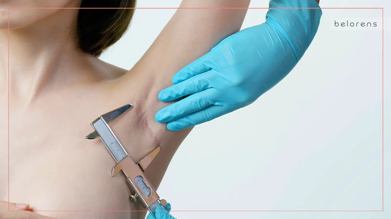 4 Types of Breast Implant Surgery Incisions | Belorens