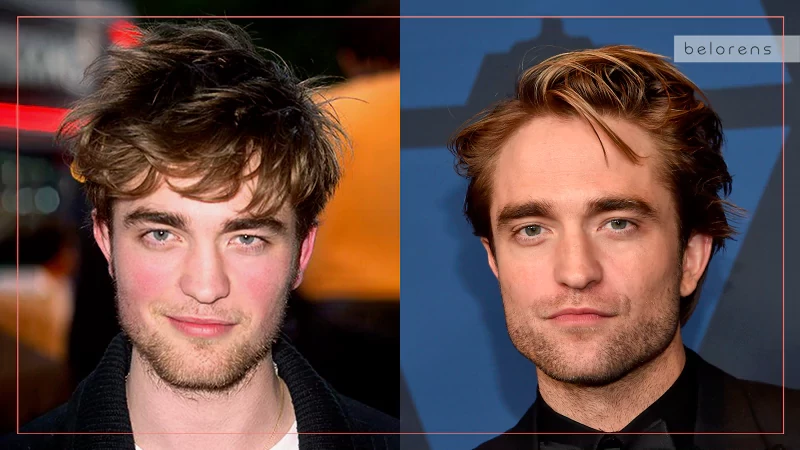 Famous People With Nose Jobs