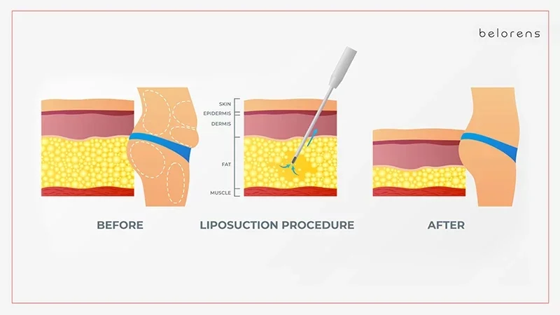 Liposuction vs Tummy Tuck (Abdominoplasty) | Belorens