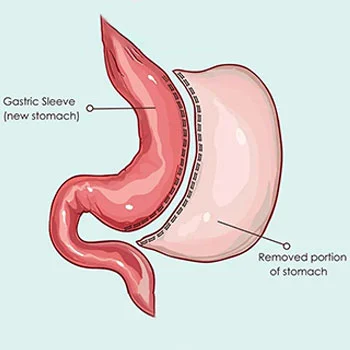 Gastric Sleeve