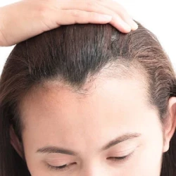 Hairline Lowering (Hair Transplant)