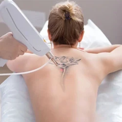 Laser Tattoo Removal