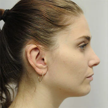 Prosthetic Ear