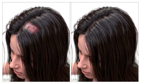 scarring hair loss before and after