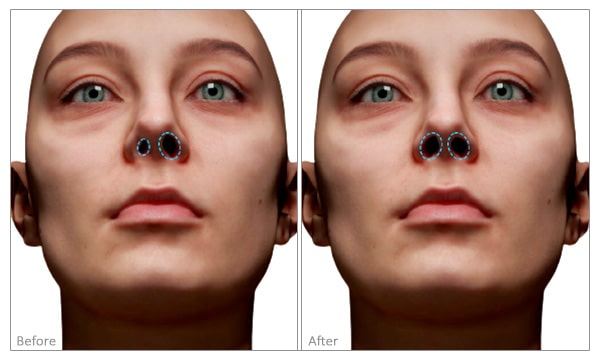 Asymmetrical Nostrils before and after