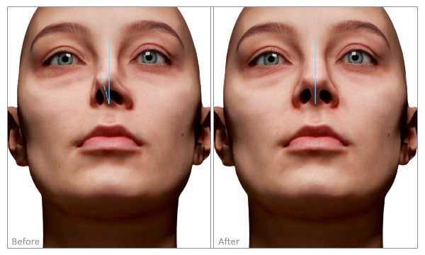 Deviated Septum before and after