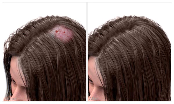 scarring hair loss before and after