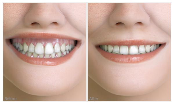Gummy Smile before and after