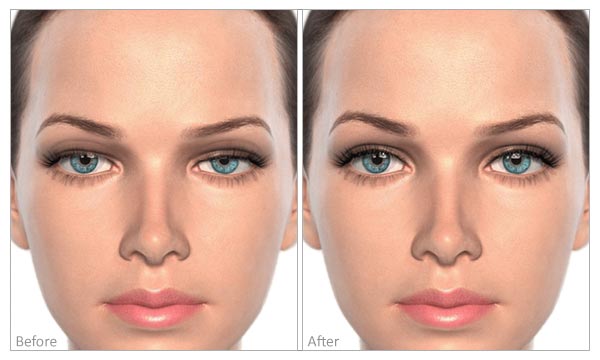 Drooping Eyelids before and after
