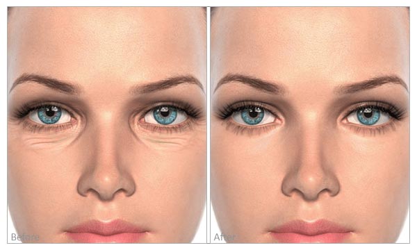 Fine Lines & Wrinkles (eyes) before and after