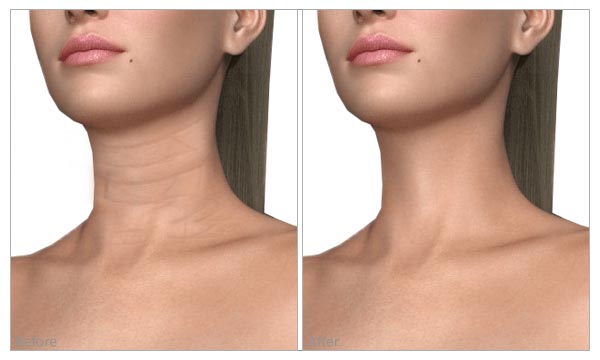 Fine Lines & Wrinkles (neck and décolletage) before and after
