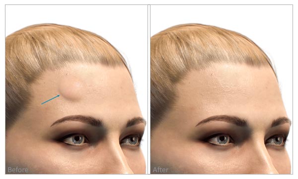 Bump on Forehead before and after