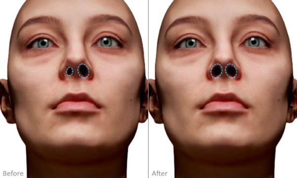 Asymmetrical Nostrils before and after