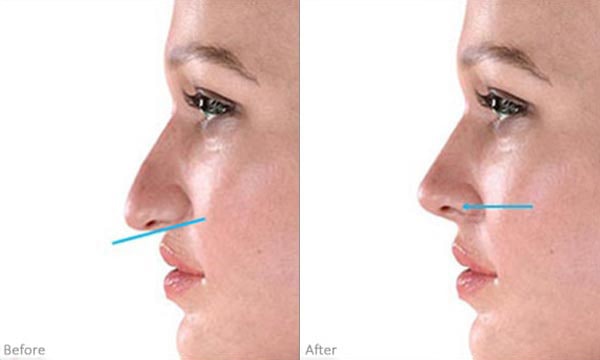 Droopy Nasal Tip before and after